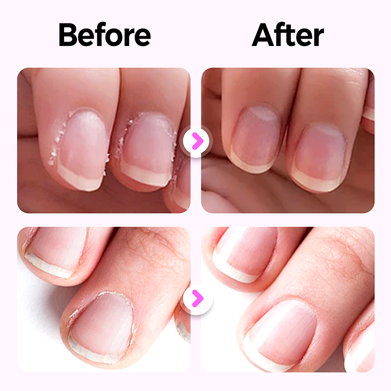 💜Compra 1, llévate 1 gratis💜Nuevo y mejorado lápiz de uñas 3 en 1 de 2025💅-ES